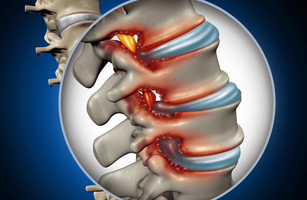 How are spinal cord injuries from auto accidents related to corpectomy and discectomy procedures?