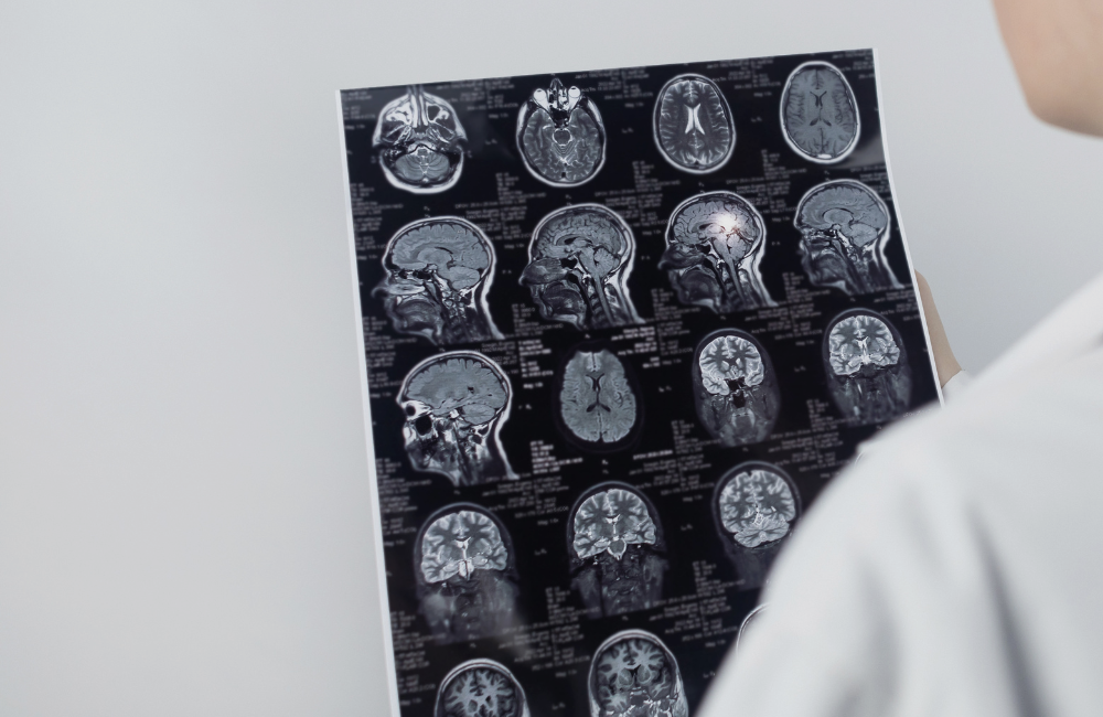 Traumatic Brain Injuries Understanding the Impact and Legal Rights